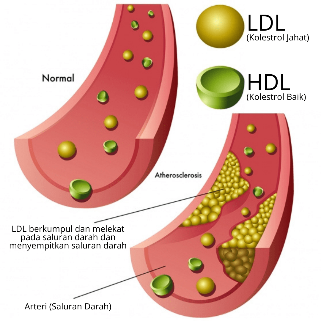 D'Aura LDL 1