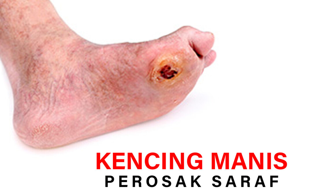 kencing manis perosak saraf