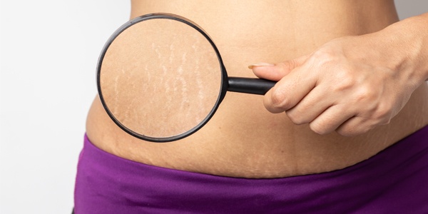 Main - Post Natal D'Aura D'Aura Mengurangkan Stretch Marks