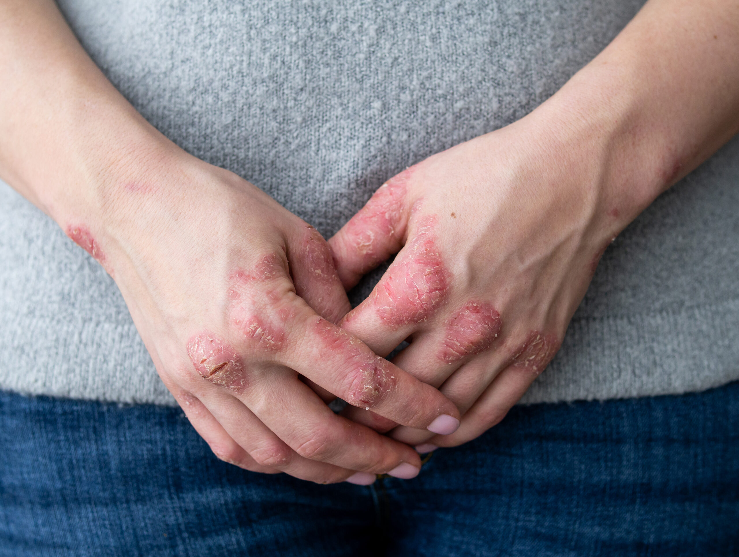 cracked-flaky-skin-hands-dermatological-problems-psoriasis D'Aura cracked flaky skin hands dermatological problems psoriasis scaled