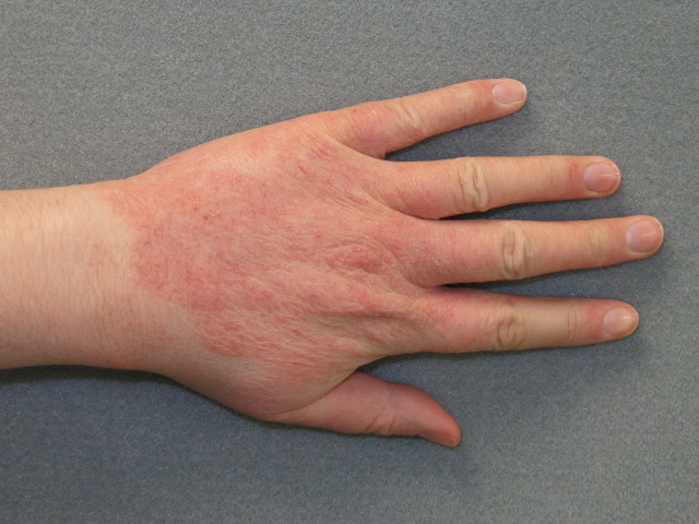 Kontaktinis-dermatitas-britishskinfoundation.org_.uk-nuotr. D'Aura Kontaktinis dermatitas britishskinfoundation.org .uk nuotr.