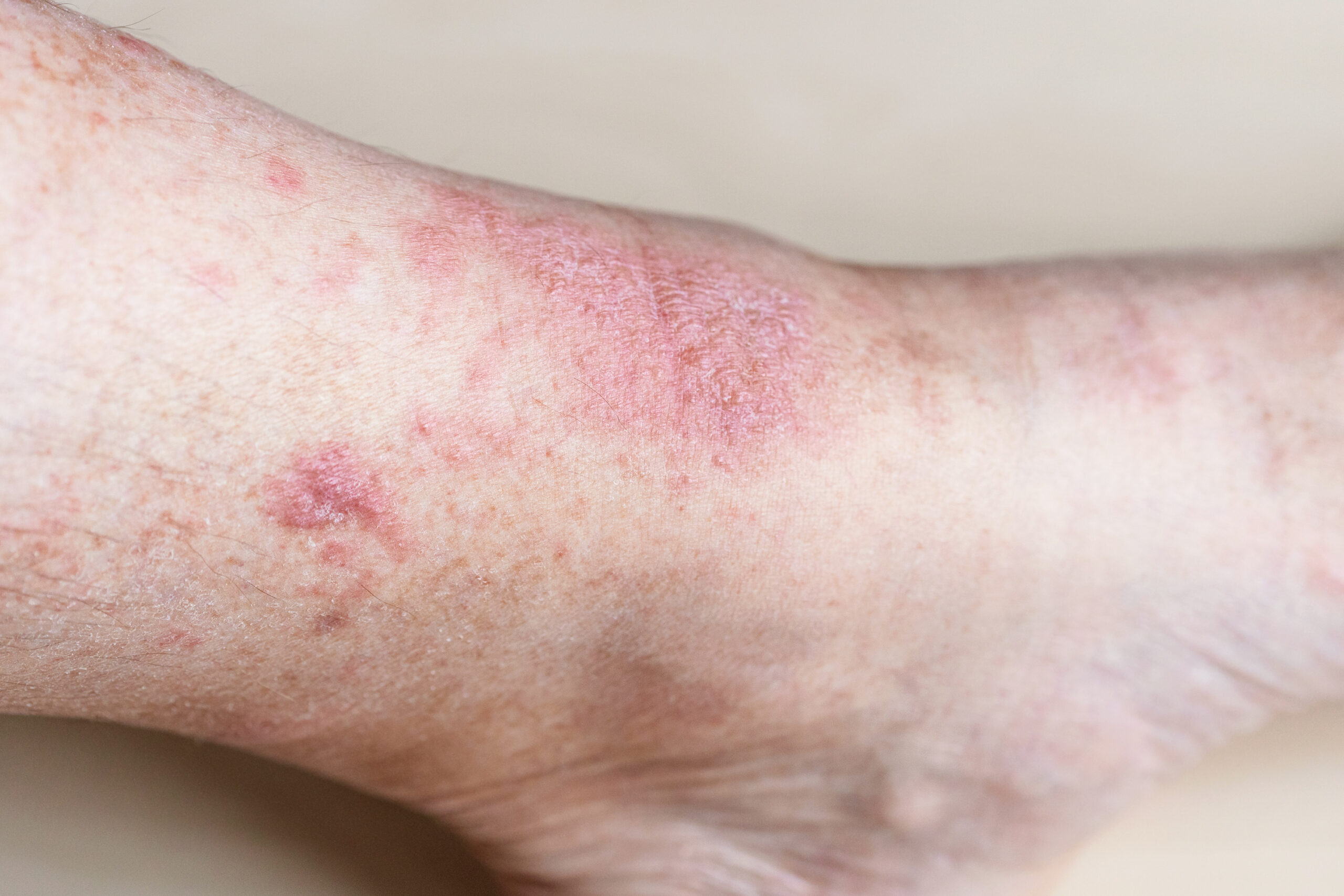 eczema on male shin close up D'Aura eczema on male shin close up 2022 01 30 02 13 09 utc scaled